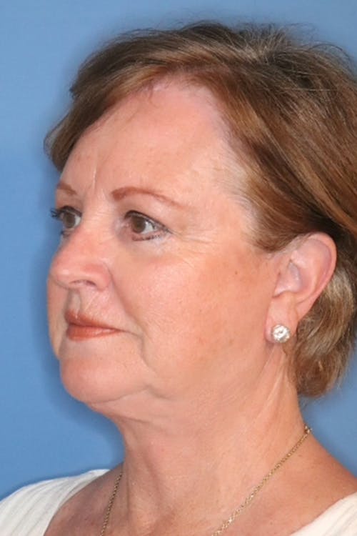 Mini Facelift Before & After Photos