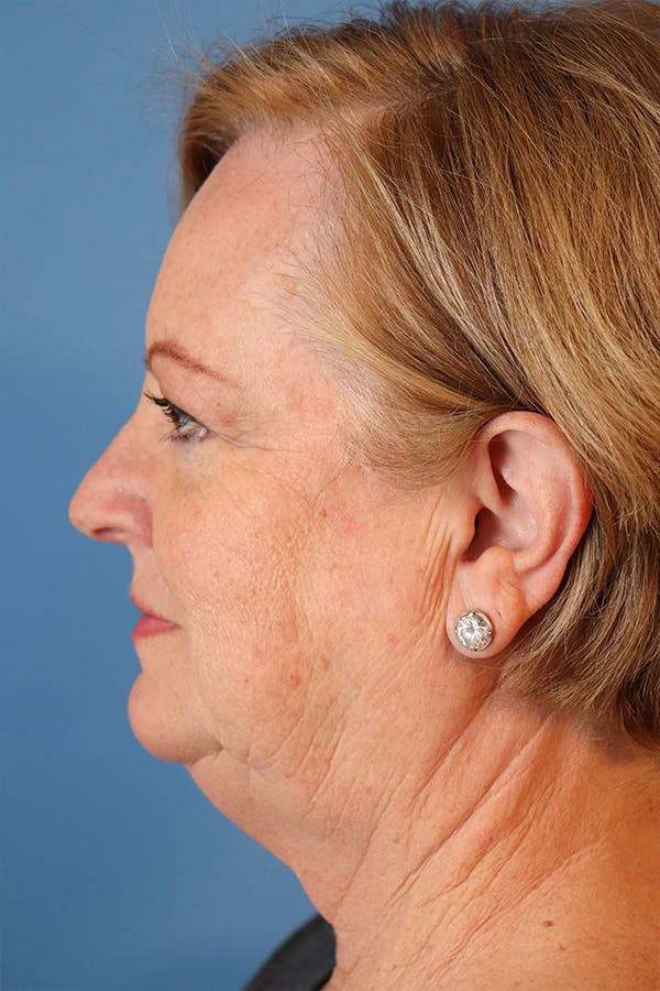 Facelift Before & After Gallery - Patient 29785271 - Image 5