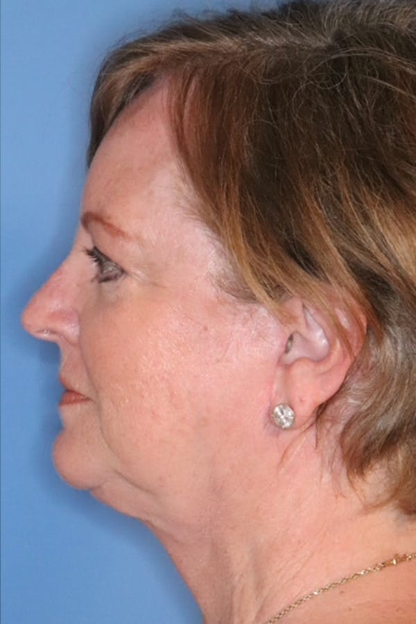 Facelift Before & After Gallery - Patient 29785271 - Image 6