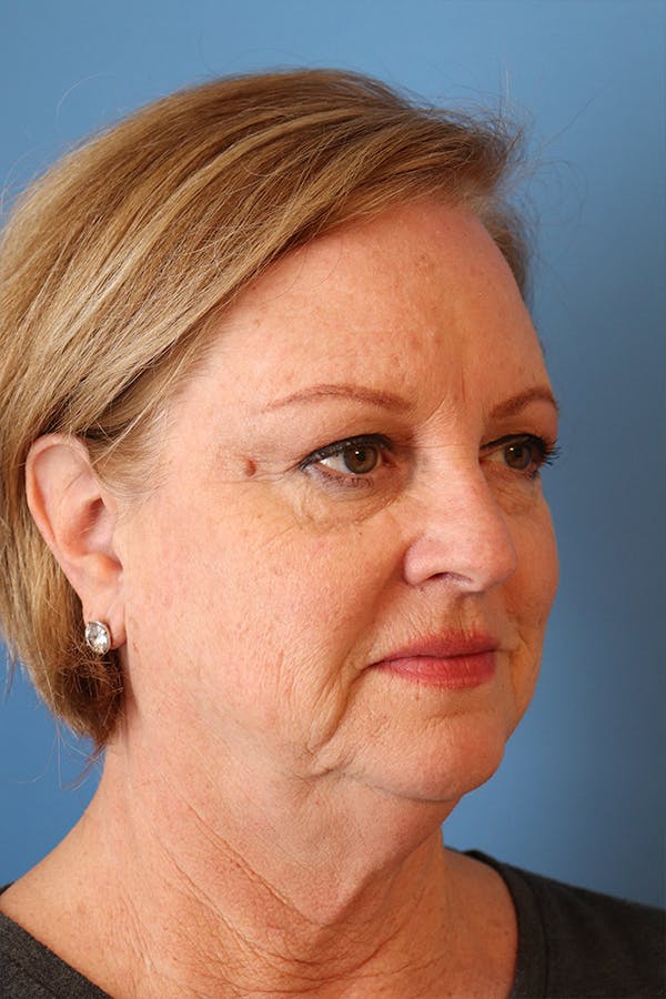 Facelift Before & After Gallery - Patient 29785271 - Image 7