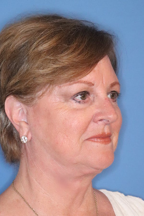 Facelift Before & After Gallery - Patient 29785271 - Image 8