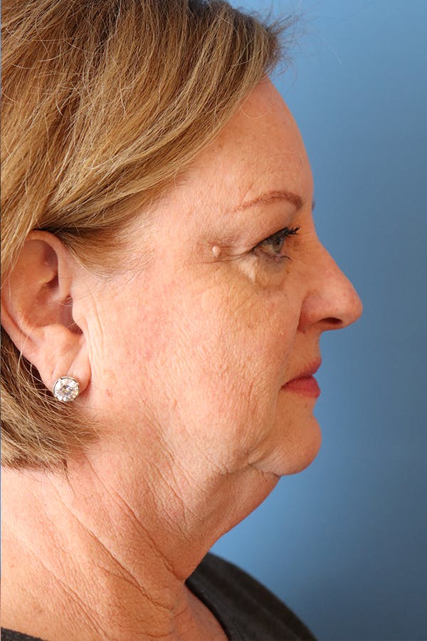 Facelift Before & After Gallery - Patient 29785271 - Image 9