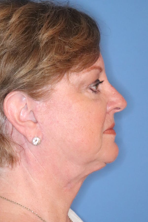 Facelift Before & After Gallery - Patient 29785271 - Image 10