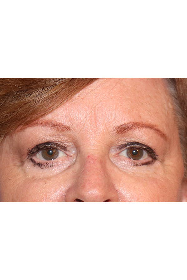 Eyelid Lift Before & After Gallery - Patient 29785295 - Image 4