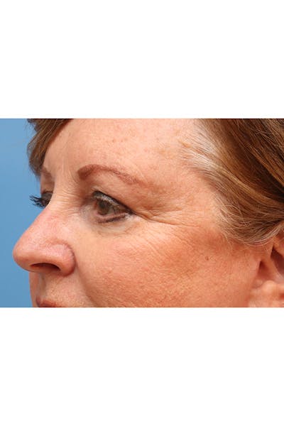 Eyelid Lift Before & After Gallery - Patient 29785295 - Image 6