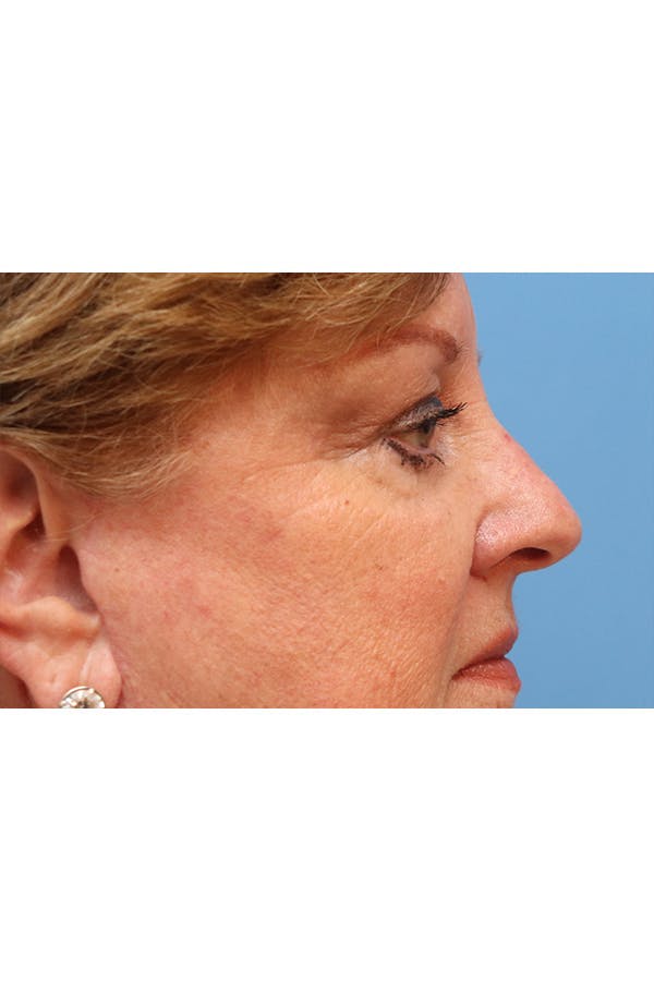 Eyelid Lift Before & After Gallery - Patient 29785295 - Image 8