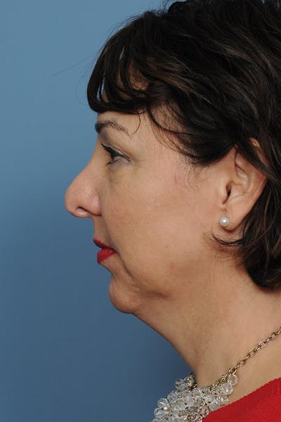 Rhinoplasty Before & After Gallery - Patient 8376729 - Image 1