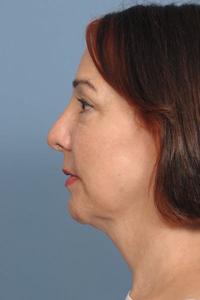 Chin Implant Before & After Gallery - Patient 12268216 - Image 4