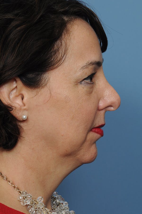Chin Implant Before & After Gallery - Patient 12268216 - Image 7