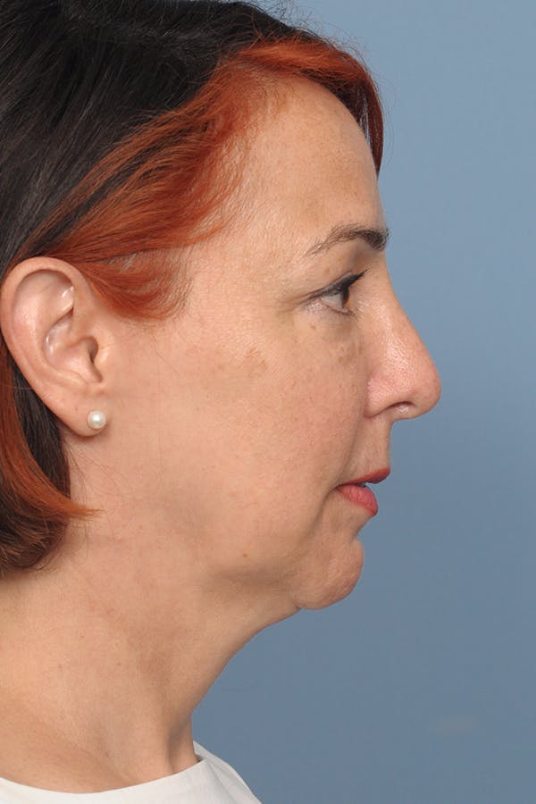 Chin Implant Before & After Gallery - Patient 12268216 - Image 8