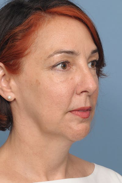 Chin Implant Before & After Gallery - Patient 12268216 - Image 10