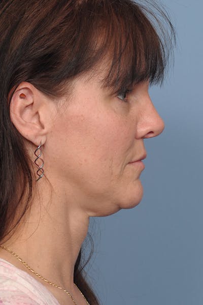 Rhinoplasty Before & After Gallery - Patient 8562223 - Image 6