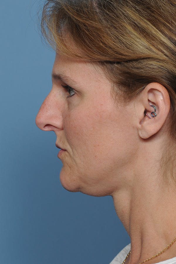 Rhinoplasty Before & After Gallery - Patient 8562223 - Image 7
