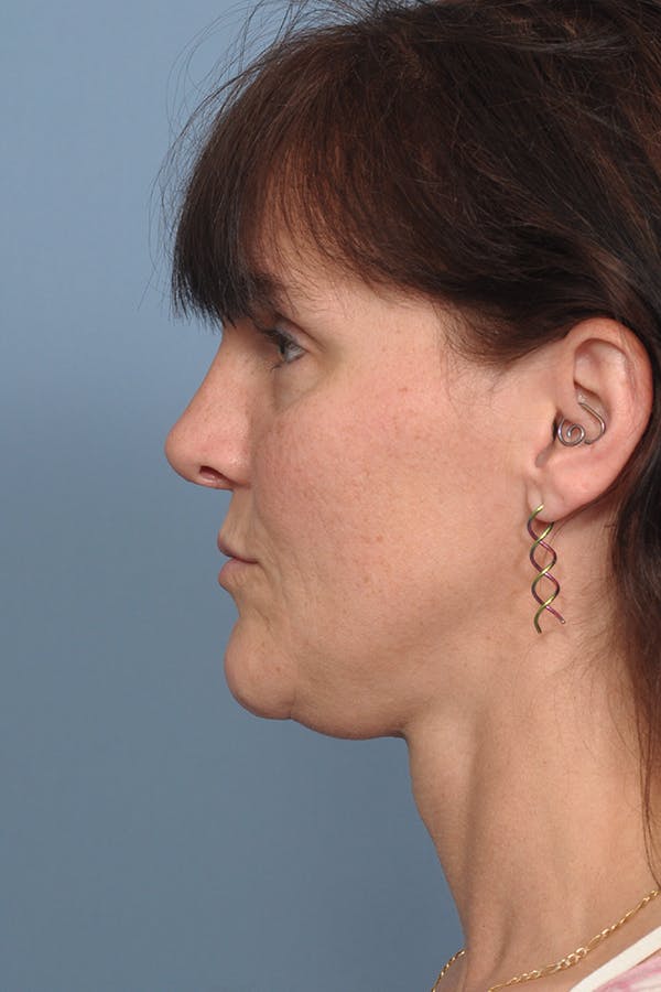 Rhinoplasty Before & After Gallery - Patient 8562223 - Image 8