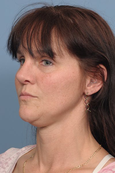 Rhinoplasty Before & After Gallery - Patient 8562223 - Image 10