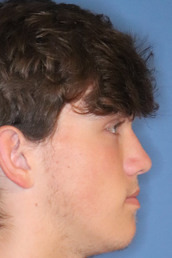 Rhinoplasty Before & After Gallery - Patient 49261259 - Image 2