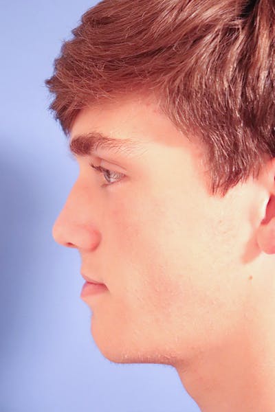 Rhinoplasty Before & After Gallery - Patient 49261259 - Image 1