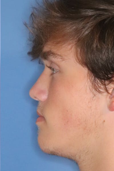 Rhinoplasty Before & After Gallery - Patient 49261259 - Image 4