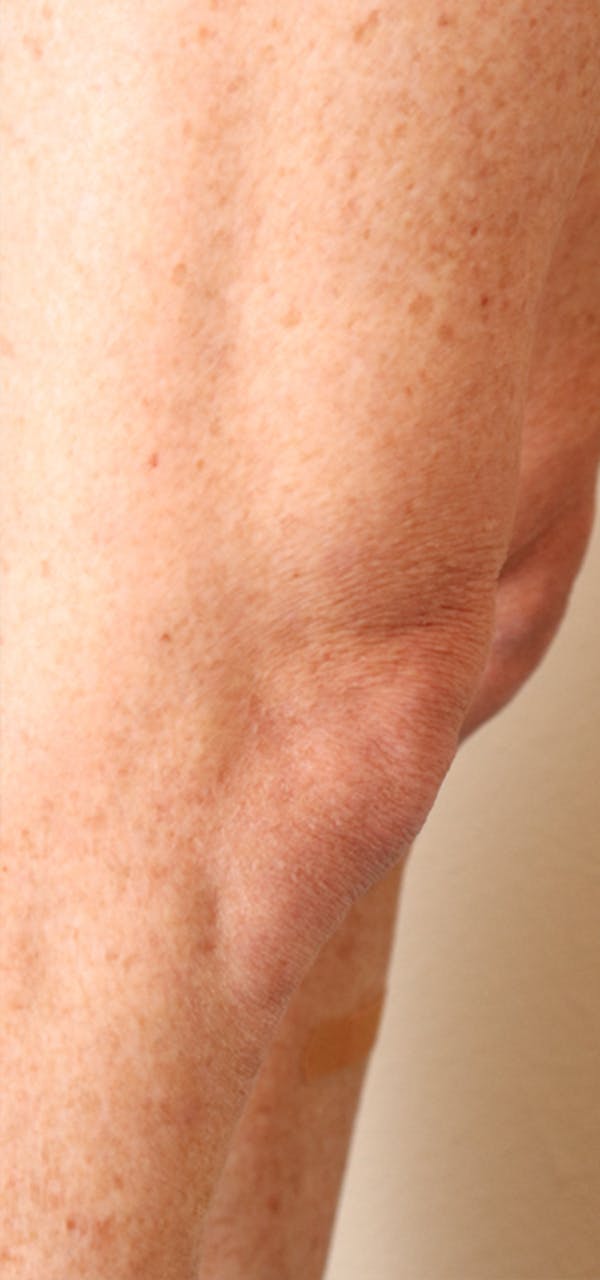 Exosome Facial Before & After Gallery - Patient 32763212 - Image 3
