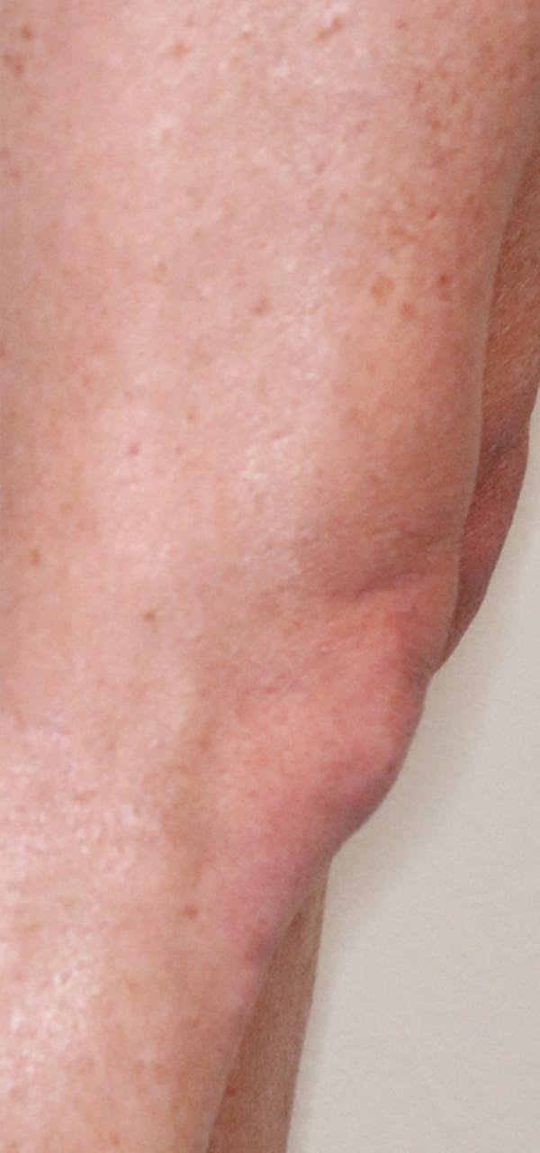 Exosome Facial Before & After Gallery - Patient 32763212 - Image 4