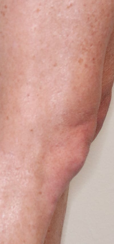 Microneedling Before & After Gallery - Patient 77040323 - Image 4