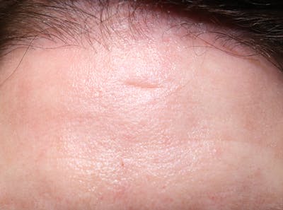 Microneedling Before & After Gallery - Patient 77040367 - Image 1