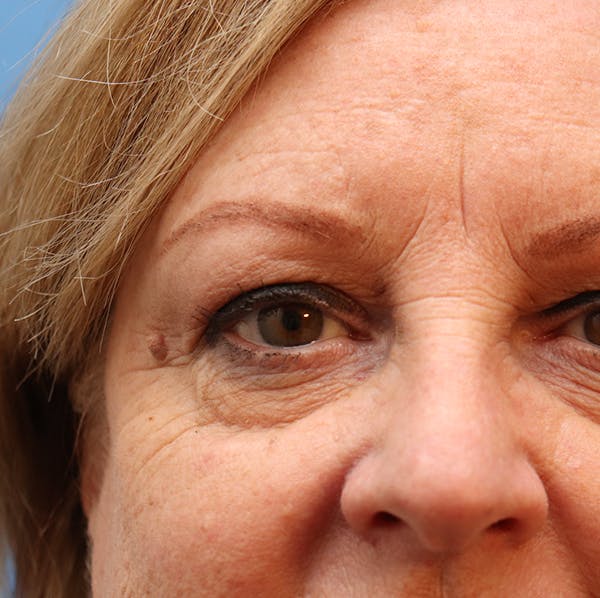 Mole Removal Before & After Gallery - Patient 32769518 - Image 5
