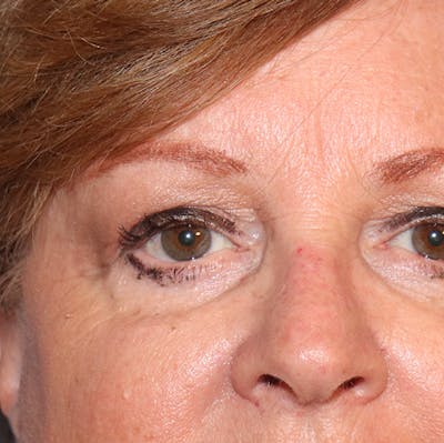 Mole Removal Before & After Gallery - Patient 32769518 - Image 6