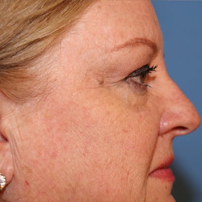 Mole Removal Before & After Gallery - Patient 32769518 - Image 1