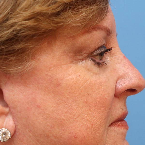 Mole Removal Before & After Gallery - Patient 32769518 - Image 2