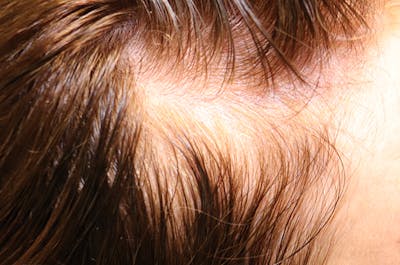 Hair Restoration with Exosomes Before & After Gallery - Patient 32769537 - Image 1