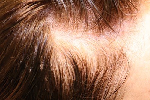 Before and after Hair Restoration with Exosomes in Austin
