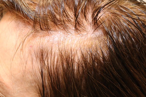 Hair Restoration with Exosomes Gallery - Patient 32769537 - Image 3