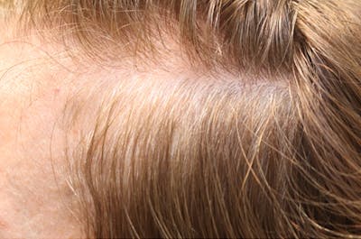 Hair Restoration with Exosomes Before & After Gallery - Patient 32769537 - Image 4