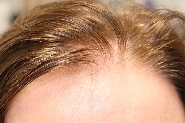 Hair Restoration with Exosomes Gallery - Patient 32769537 - Image 7