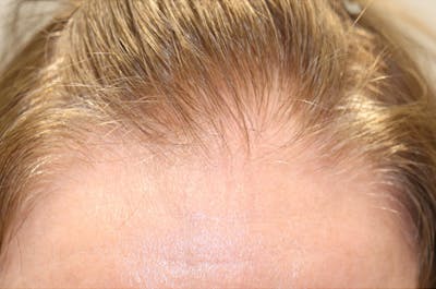Hair Restoration with Exosomes Before & After Gallery - Patient 32769537 - Image 8