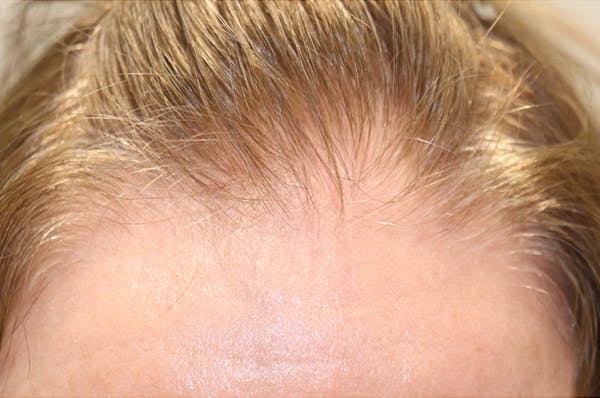 Hair Restoration with Exosomes Gallery - Patient 32769537 - Image 8