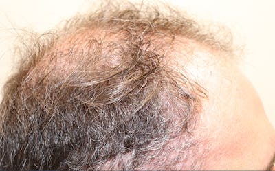 Hair Restoration with Exosomes Gallery - Patient 37796886 - Image 1