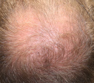 Hair Restoration with Exosomes Gallery - Patient 37796886 - Image 4