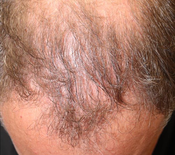 Hair Restoration with Exosomes Gallery - Patient 37796886 - Image 6
