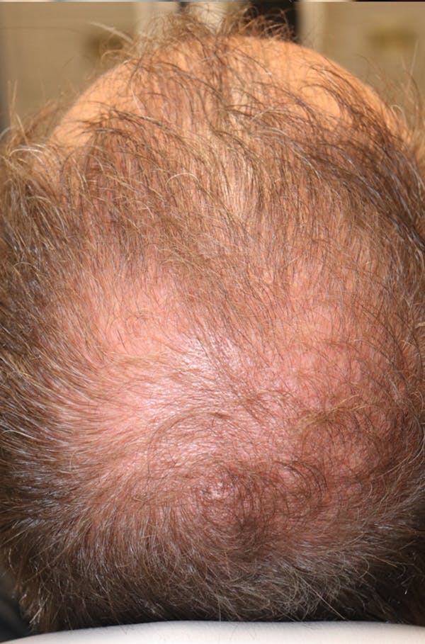Hair Restoration with Exosomes Gallery - Patient 37796886 - Image 8