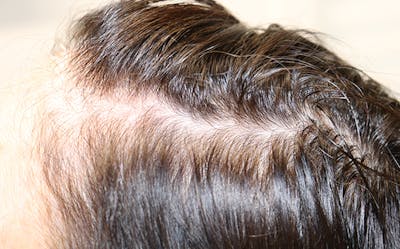 Hair Restoration with Exosomes Before & After Gallery - Patient 39167685 - Image 1
