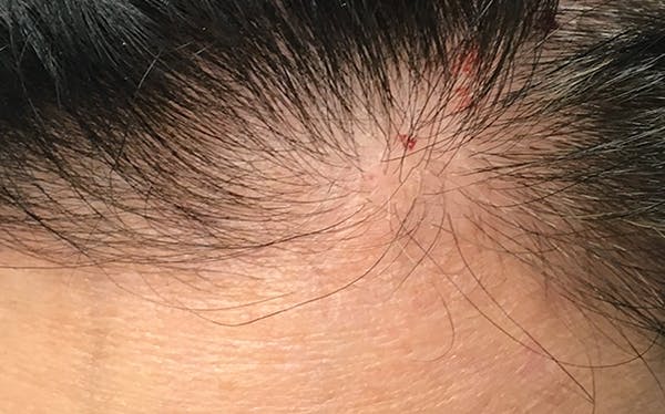 Hair Restoration with Exosomes Before & After Gallery - Patient 39167685 - Image 7