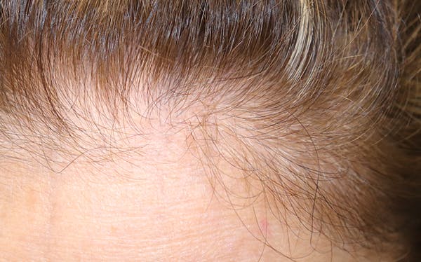 Hair Restoration with Exosomes Gallery - Patient 39167685 - Image 8
