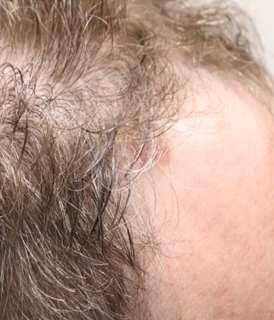 Hair Restoration with Exosomes Before & After Gallery - Patient 49275868 - Image 1