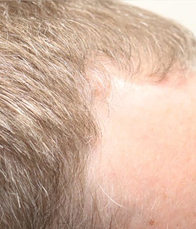 Hair Restoration with Exosomes Before & After Gallery - Patient 49275868 - Image 2