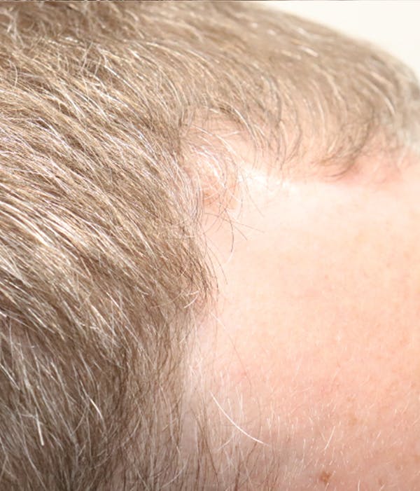 Hair Restoration with Exosomes Before & After Gallery - Patient 49275868 - Image 2