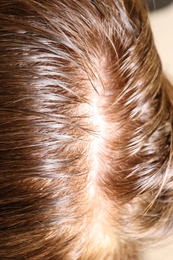 Hair Restoration with Exosomes Gallery - Patient 32769537 - Image 5