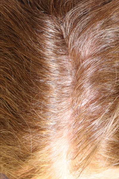 Hair Restoration with Exosomes Gallery - Patient 32769537 - Image 6