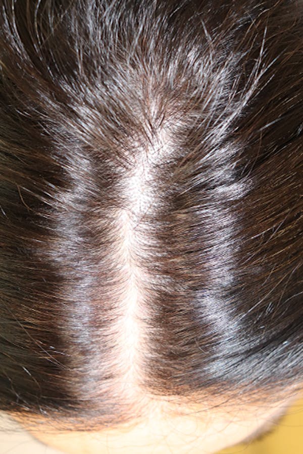 Hair Restoration with Exosomes Before & After Gallery - Patient 39167685 - Image 5